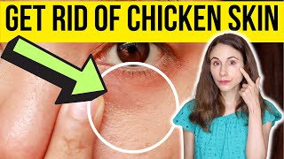 HOW TO GET RID OF CHICKEN SKIN UNDER EYES  Dermatologist [upl. by Xenia]