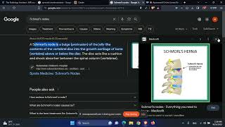 רדיולוגיה עמוד שדרה קשריות שמורל Schmorls nodes [upl. by Kamin432]