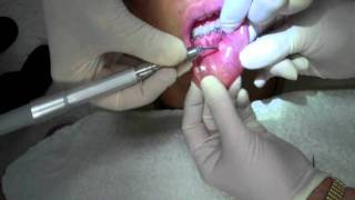 Mucoclele Removal with Laser  Cosmetic Dentist Palmdale CA [upl. by Chura]