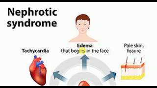 Nephrotic Syndrome  MEDICINE Lectures  NEPHROLOGY  TP 8 [upl. by Fink]