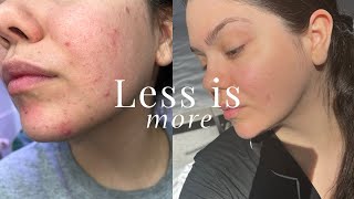 NOT Having a Skincare Routine Saved My Skin [upl. by Eslehc]