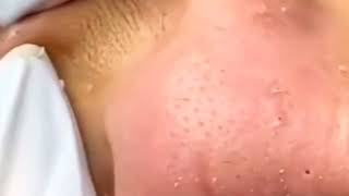 blackheads removal 2023  sac dep spa blackheads removal 2023  skin treatments sac dep spa 2023 44 [upl. by Amersham]