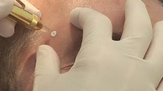 Removing warts how to [upl. by Burta496]