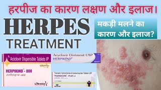 Herpes zoster cause Symptoms Treatment in Hindi हरपीज जोस्टर कारण लक्षण व इलाज [upl. by Abekam]