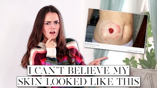 How I Healed the Skin Around My Stoma  Lets Talk IBD [upl. by Lovato]