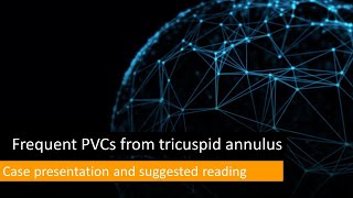 Frequent PVCs from RV inflow tricuspid annular PVC [upl. by Tiphane]