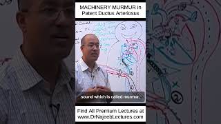 MACHINERY MURMUR In Patent Ductus Arteriosus shortvideo shorts drnajeeb lecture [upl. by Netnilc878]