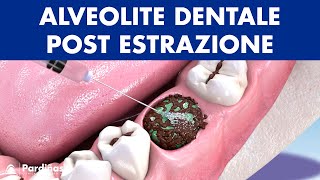 ALVEOLITE DENTALE post estrazione del dente  Cause e trattamento © [upl. by Stannwood]