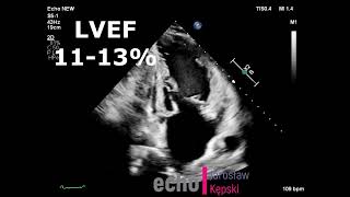 Late cardiotoxicity AC amp RTx Hodgkins disease heart failure GLS Global Longitudinal Strain 45 [upl. by Ycnahc]