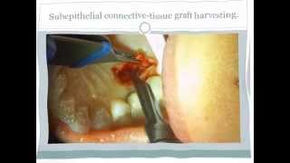 Dental Soft Tissue Graft [upl. by Flory]