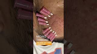 Reduced Acne Scars In Just 15 Days  Mono Thread amp Fractional Laser At Musk Clinic Ahmedabad [upl. by Thompson]