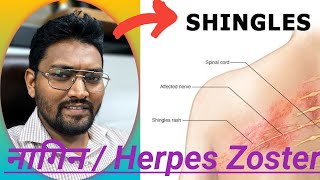 Herpes Zoster Virus in hindi shingles  viral skin infection  symptoms  treatment [upl. by Munmro]