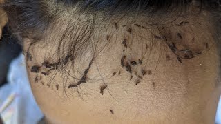 How to remove all hundred head lice at home  Head lice removal at home [upl. by Annais394]