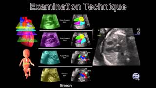 The Fetal HeartThe Transverse Sweep [upl. by Grail]