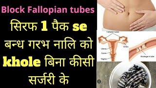 fellopian tube blockage in hindi  fellopian tube blockage treatment heenhaealth [upl. by Etnaik]