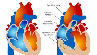 Tetralogy of Fallot [upl. by Mairym]