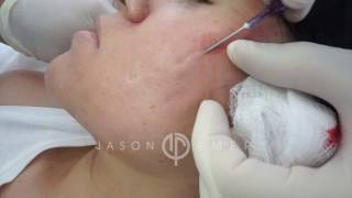 Subcision for Acne Scars  Acne Scar Treatment  Cheek Acne Scar Removal  Dr Jason Emer [upl. by Salamanca]