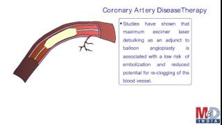 Angioplasty Excimer Laser [upl. by Arvie]