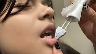 Cryotherapy for Mucous Retention Cyst Mucocele Removal [upl. by Ivek]