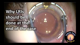 Cataract Surgery with a Limbal Relaxing Incision LRI to Correct Astigmatism [upl. by Atikkin]