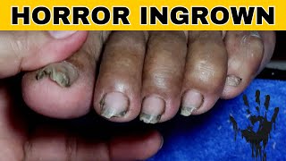 Ingrown Toenail Removal Pedicure [upl. by Inus]