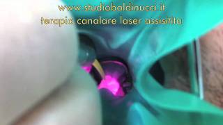 Terapia canalare laser assistitam4v [upl. by Eelrehpotsirhc]