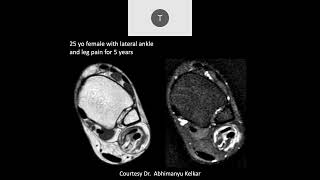 MRI of the Ankle Part 6 – Ankle Tendons [upl. by Irem168]