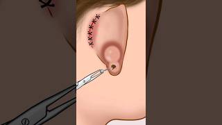 ASMR Infected ear piercing removal animation P2 animation asmr satisfying viral shorts [upl. by Aracahs229]