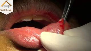 Mucocele Excigen using Lazer Hindi हिन्दी [upl. by Madaras]