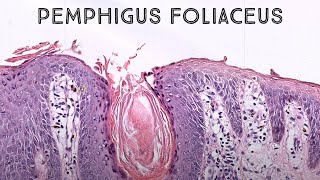 Pemphigus foliaceus autoimmune skin blister immunobullous disease in pemphigus vulgaris family [upl. by Scrivens951]