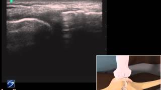 How To Ultrasound Exam of the Medial Collateral Ligament 3D Video [upl. by Assinna449]