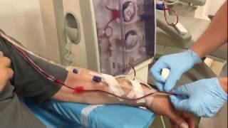 Dialysis connection of a patient with an arteriovenous fistula [upl. by Anuayek801]