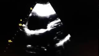 Echocardiogram  lipomatous infiltration of the atrial septum [upl. by Artenak]