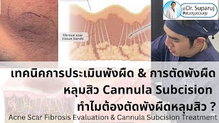 เทคนิคการประเมินพังผืด และการตัดพังผืดหลุมสิว Cannula Subcision ทำไมต้องตัดพังผืดรักษาหลุมสิว [upl. by Eadmund]