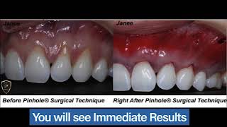 Pinhole Surgical Technique – Find A Certified Dentist [upl. by Onaireves]