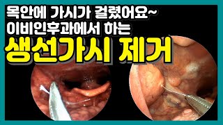 이비인후과 생선가시 제거 Fishbone removal [upl. by Zere305]