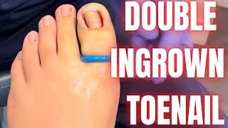 Removing an Ingrown Toenail [upl. by Negam]