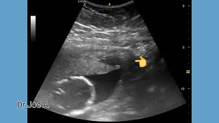 Multiple retroplacental hematomas in pregnancy ultrasound and color Doppler video [upl. by Ladnik]