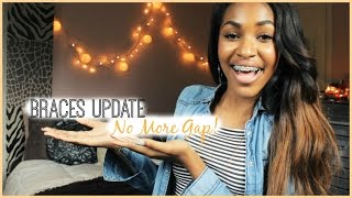 NO MORE GAP Braces Update [upl. by Walcott]