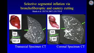 Keynote Lecture Open thoracoscopic and robotic segmentectomy for lung cancer [upl. by Tremaine863]