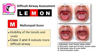 Lemon Criteria for Difficult Airway Assessment [upl. by Lerrej878]