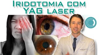 Iridotomia com YAG laser [upl. by Sender]