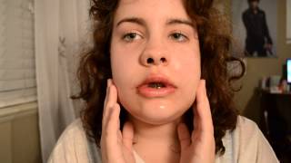 Day two after Double Jaw Surgery  Genioplasty [upl. by Jacqueline]