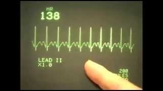 EKC ECG rhythms 1 Normal range of rhythms [upl. by Mohr]