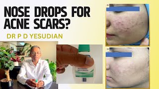 Nose drops for acne scars Topical Oxymetazoline for postacne scars [upl. by Ribak]