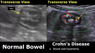 Small Bowel Ultrasound Normal Vs Abnormal Image Appearances  Gastrointestinal Tract GIT USG [upl. by Rogovy]