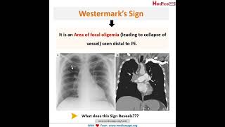 westermarks Sign Doctors Lifeplanetearth⚕️DAMS prepladder marrow neet medicoapps [upl. by Ardnola]