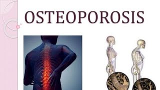 Osteoporosis Causes Symptoms Treatment [upl. by Ailatan]