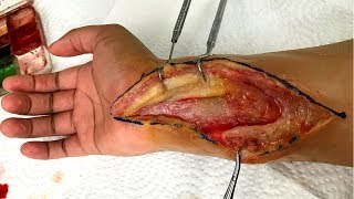 Open Wrist Surgery Effect amp Removal Creation [upl. by Ernie995]