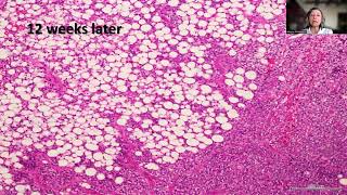 Tip54Bifocal Cerebellar Liponeurocytoma with Atypical Features [upl. by Kirenoj]